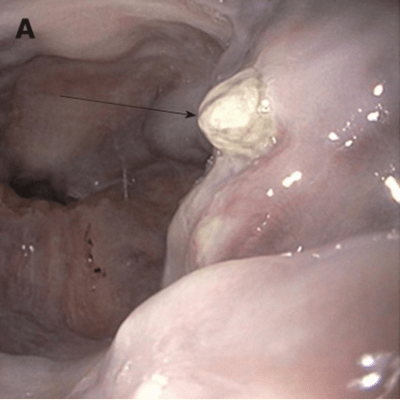 симптом белого сосочка